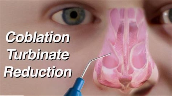 Is coblation turbinate reduction safe?