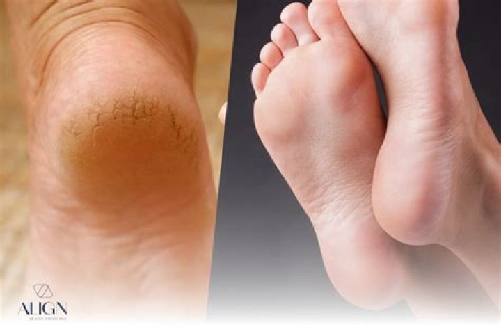 Is Cracked heels a vitamin deficiency?