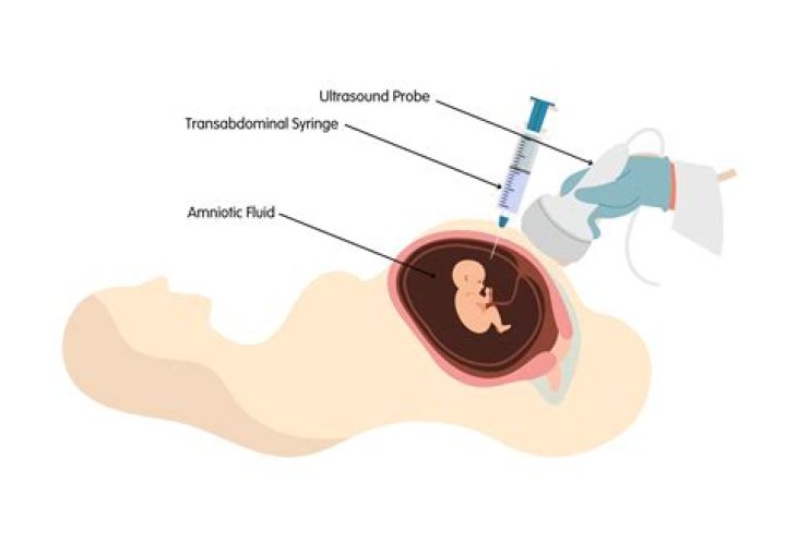 Is CVS riskier than amniocentesis