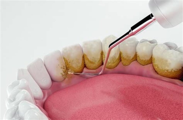 Is dental covered under Champva?