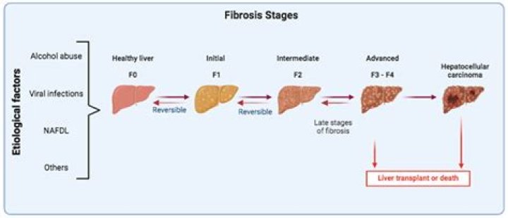 Is fibrosis a restrictive disease?