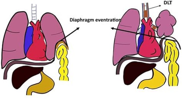 Is it possible to live with a paralyzed diaphragm?