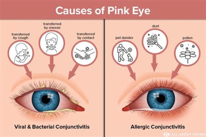 Is pink eye a side effect of coronavirus?