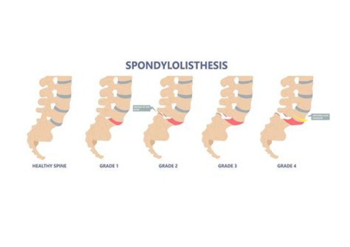 Is spondylolisthesis serious?