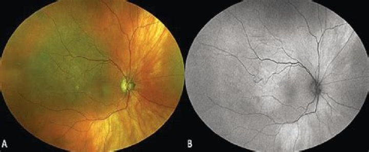 Is the choroid pigmented
