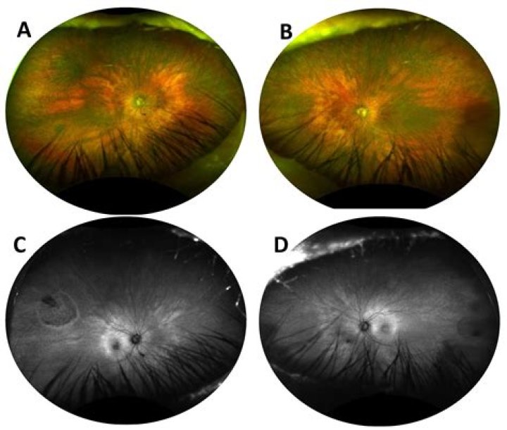 Is there a cure coming soon for retinitis pigmentosa?