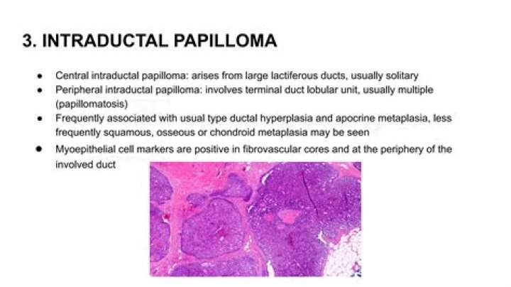 What are the symptoms of intraductal papilloma?
