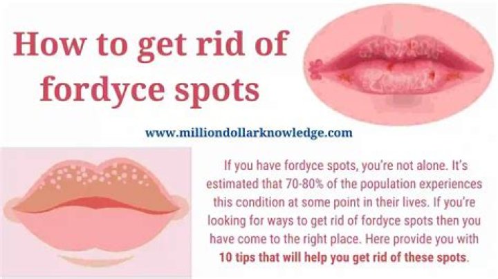 What can Fordyce spots be mistaken for
