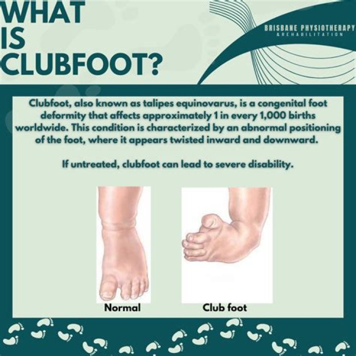 What causes clubfoot in a fetus?