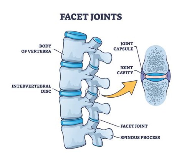 What causes facet effusions?