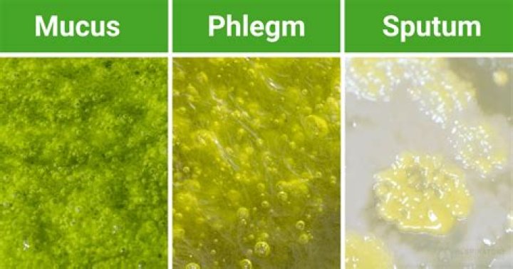 What causes green foul smelling sputum?