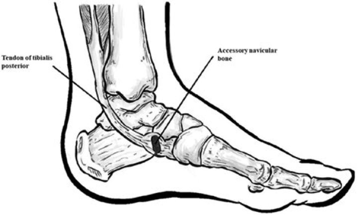 What causes os tibiale externum?
