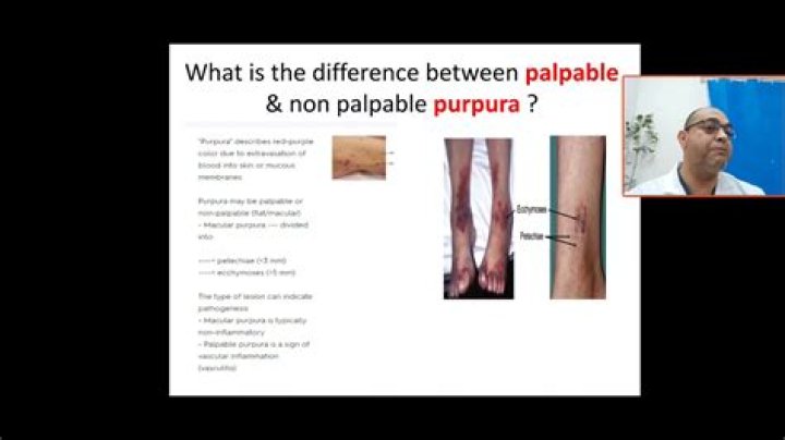 What causes palpable purpura?