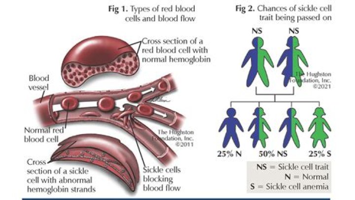 What causes sickle cell anemia