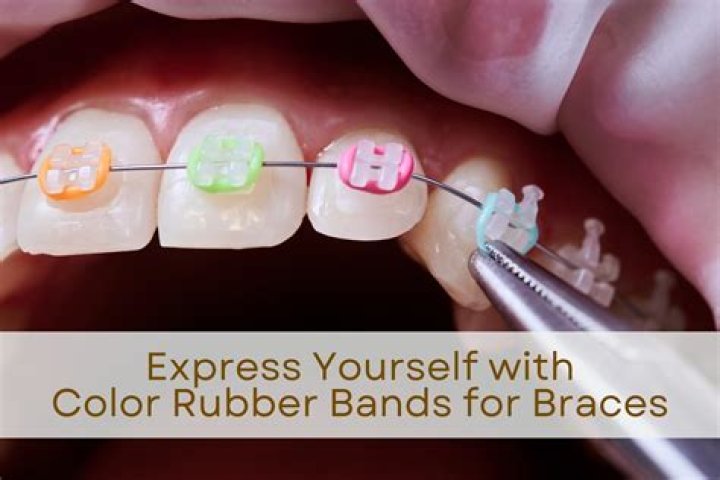 What colors do rubber bands for braces come in?