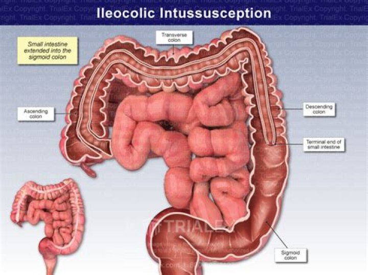 What comes out in a colonic?