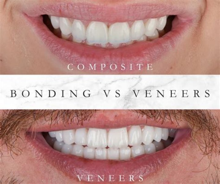 What disqualifies you from getting veneers?