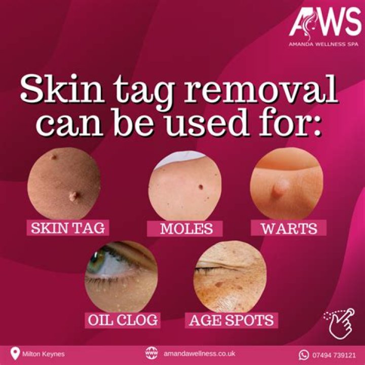 What does a skin tag on your tongue mean?