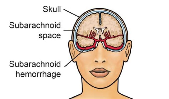 What does a subarachnoid hemorrhage look like on CT scan?
