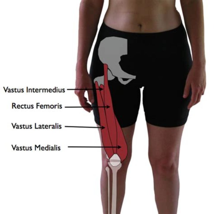 What does a torn vastus medialis feel like?