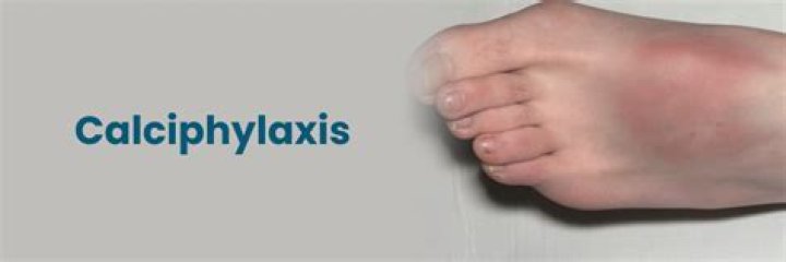 What does Calciphylaxis mean?