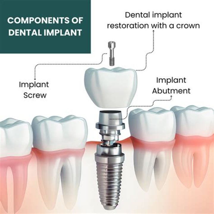 What does dental abutment mean?