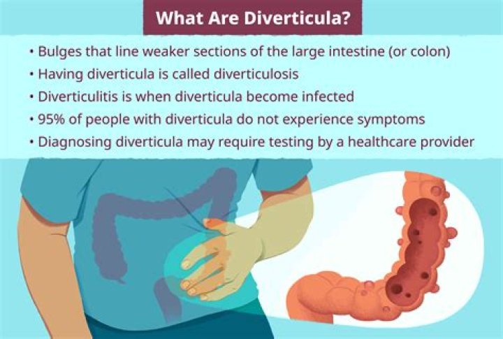 What does diverticulosis feel like?