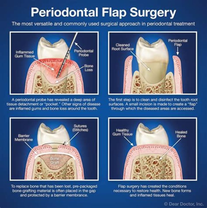 What does flap mean in dentistry?