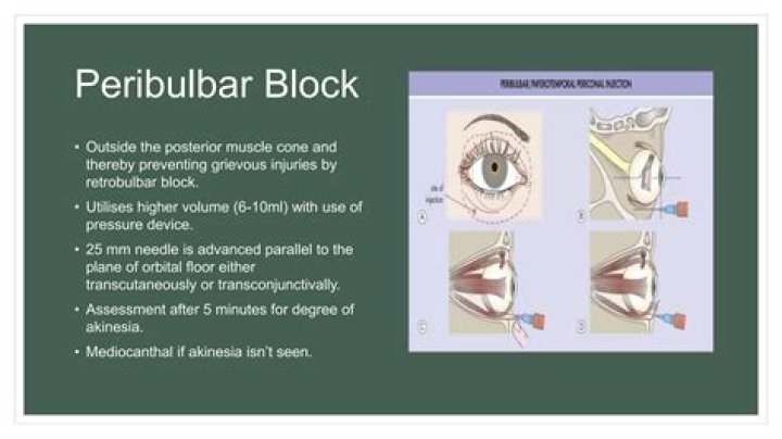 What does Peribulbar mean? | ContextResponse.com