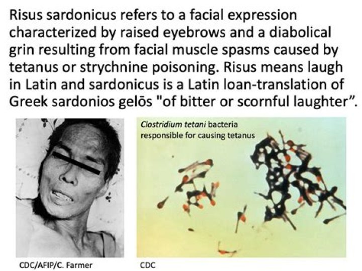 What does risus sardonicus meaning?