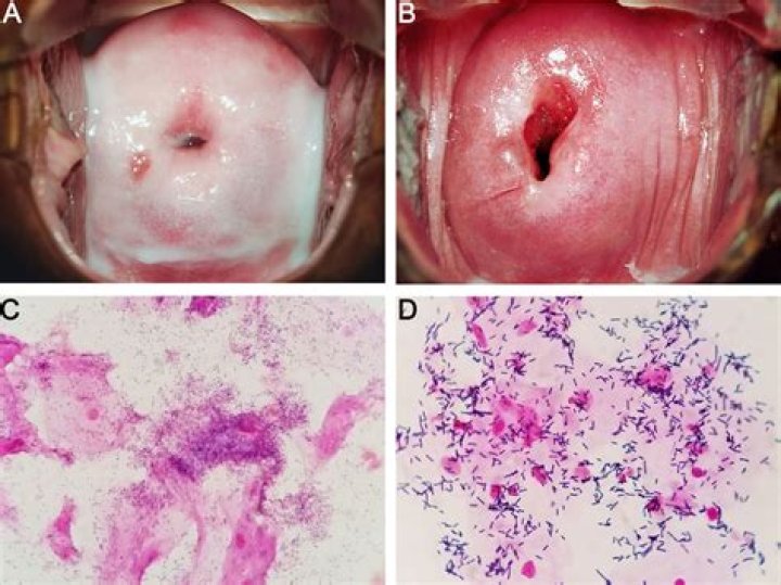 What does vulvovaginitis look like?