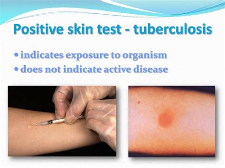 What indicates a positive TB test?