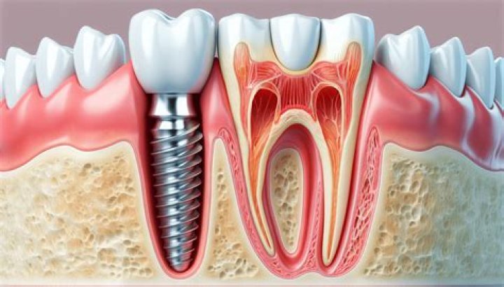What is a dental ERA attachment?