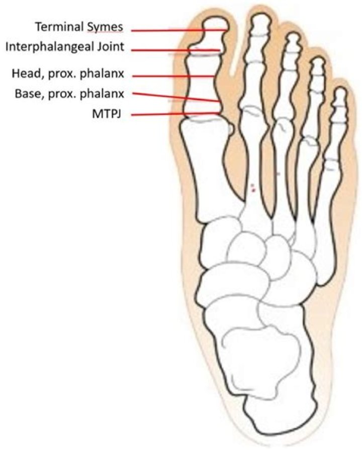 What is a hallux amputation?