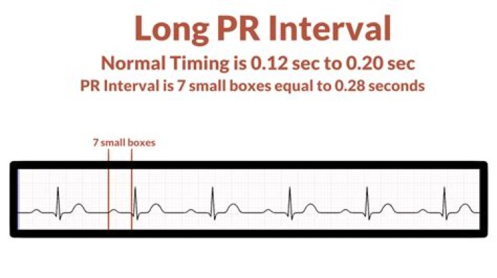 What is a prolonged PR interval indicate?