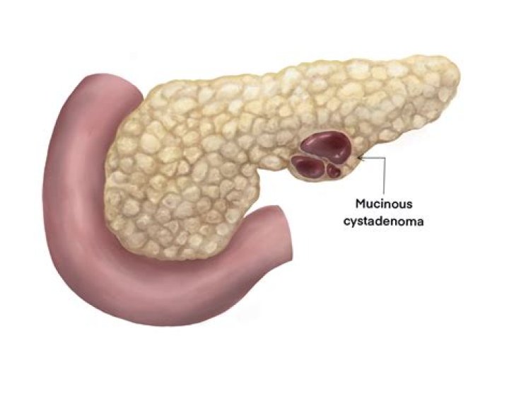 What is a Seromucinous cystadenoma?