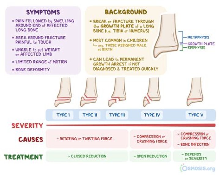 What is a Stage 4 fracture?