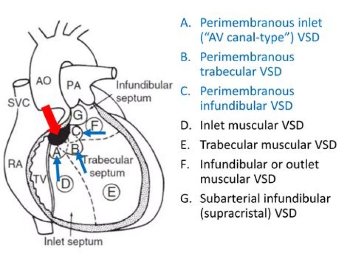 What is a Subarterial VSD?