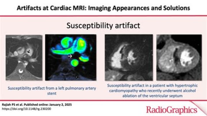 What is a susceptibility artifact