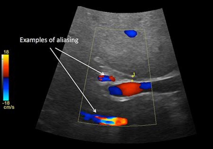 What is aliasing in Doppler ultrasound