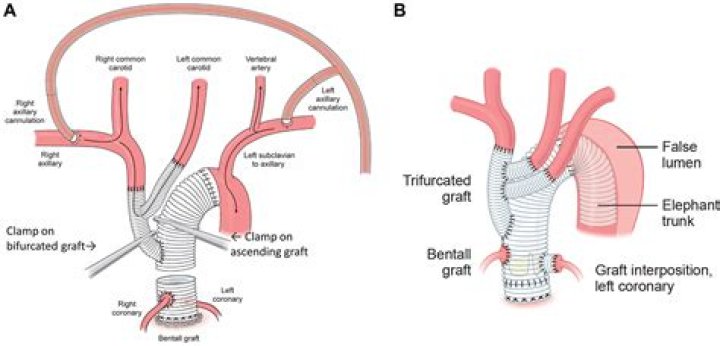 What is aortic Hemiarch graft?