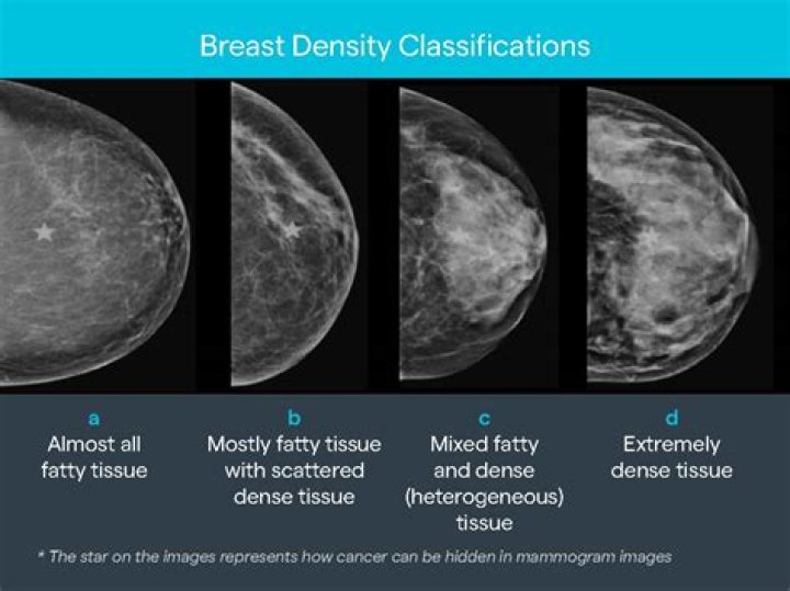 What is Breast density classification?