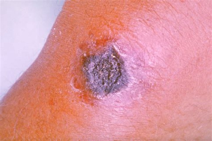 What is cutaneous anthrax