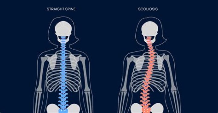 What is Dorsopathy Dorsalgia?