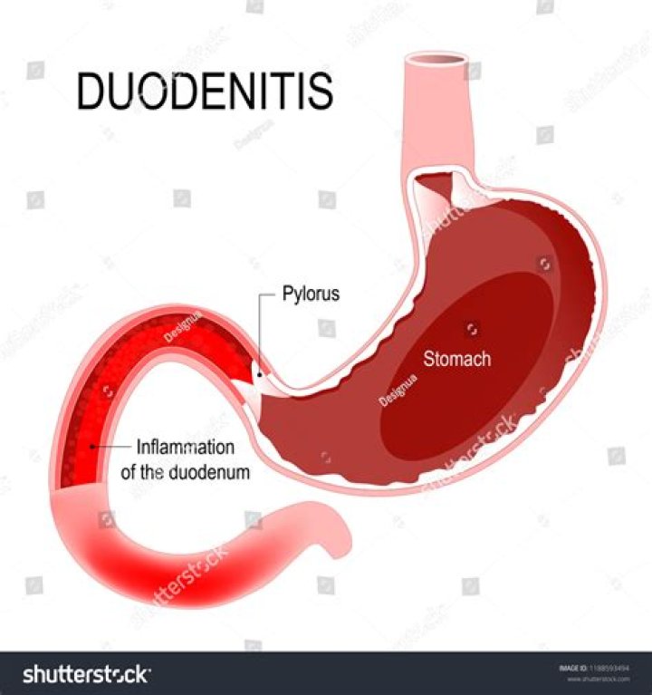 What is duodenitis in the duodenal bulb?