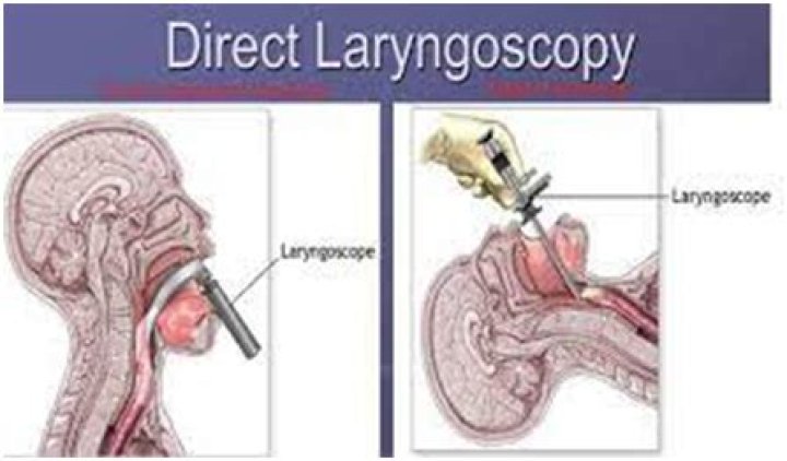 What is laryngoscopy with biopsy?