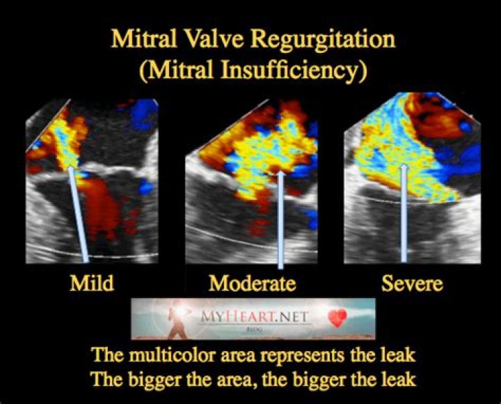 What is moderate to severe mitral regurgitation?