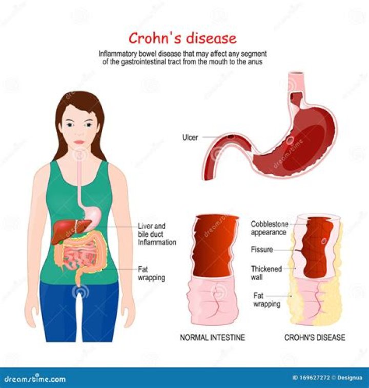 What is Morbus Crohn?