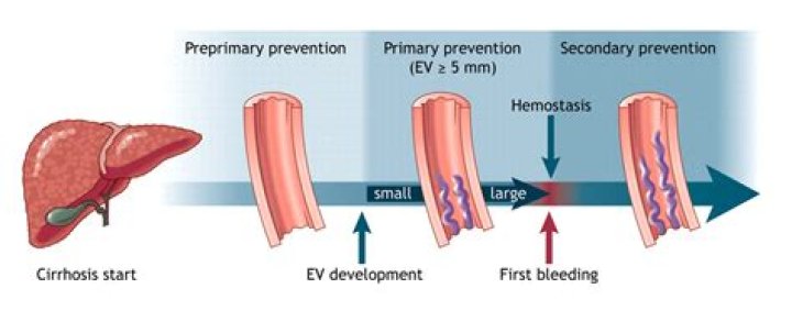 What is refractory ascites?