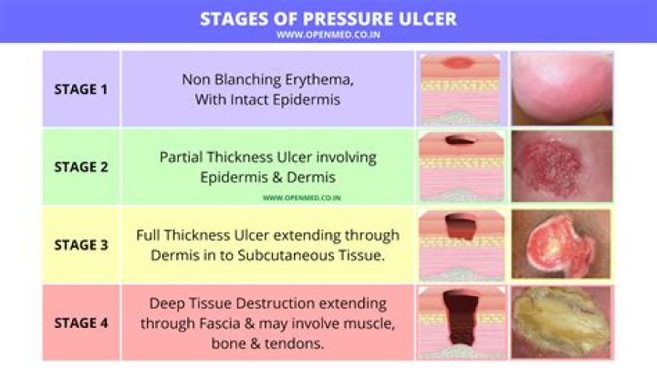 What is the difference between a pressure sore and an ulcer
